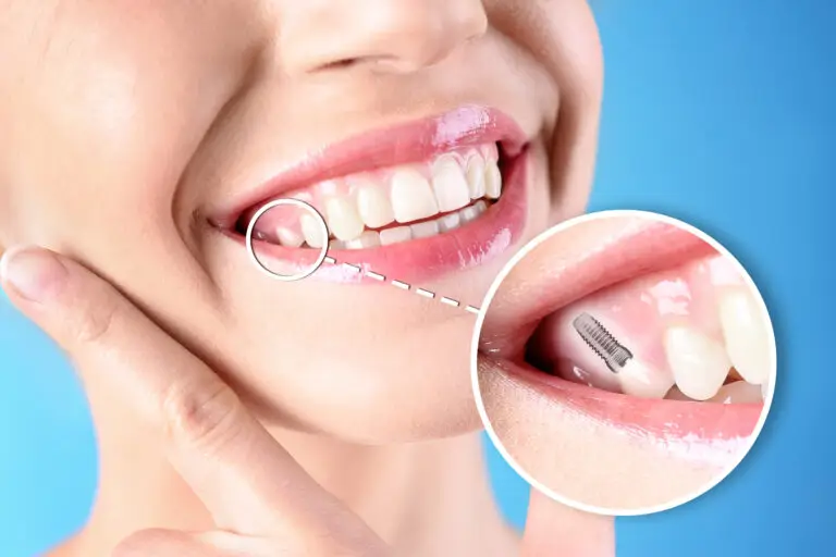 Single Dental Implant