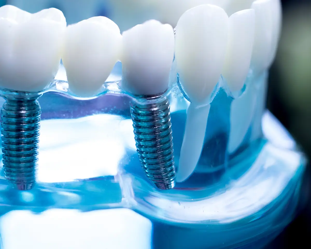 single dental implants