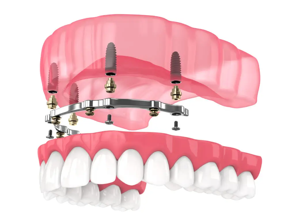 Locator Dentures