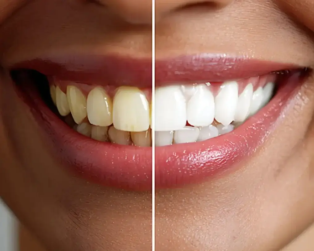 Smile Makeovers in Marietta, GA